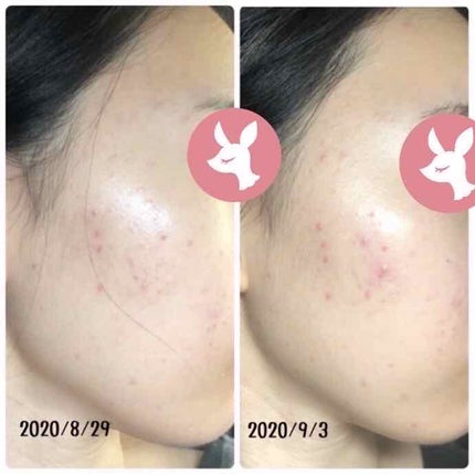 アクネケア セット MB/d プログラム/トライアルキットを使ったクチコミ(2枚目)