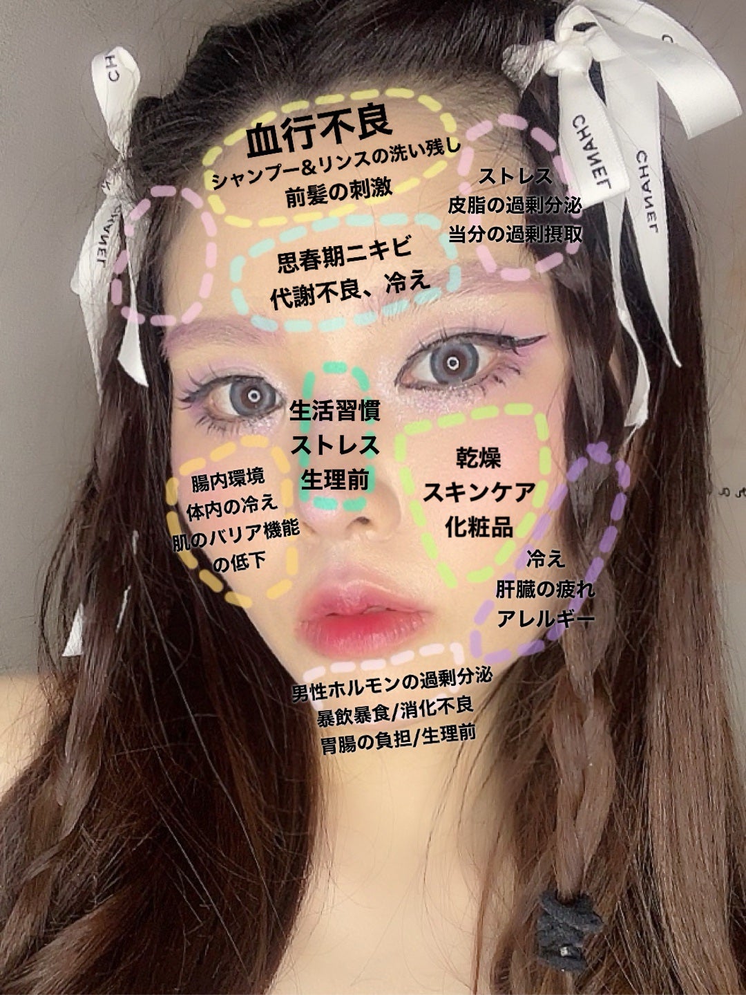 かみれな on LIPS 「これを見れば一目瞭然‼️
ニキビの原因が一目でわかる保存版マッ..」(2枚目)