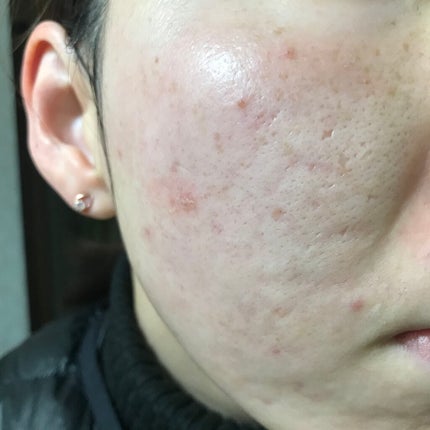 ゼロスポットパッチ/Today’s Cosme/にきびパッチを使ったクチコミ(1枚目)