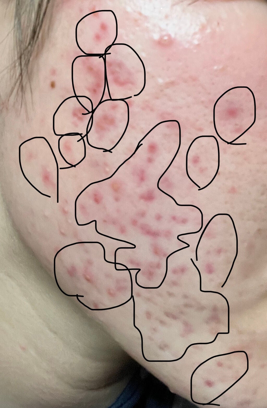 supreme_glow_85j9 on LIPS 「汚くてすみません。ニキビ跡がひどいです。塗り薬などおすすめなの..」(1枚目)