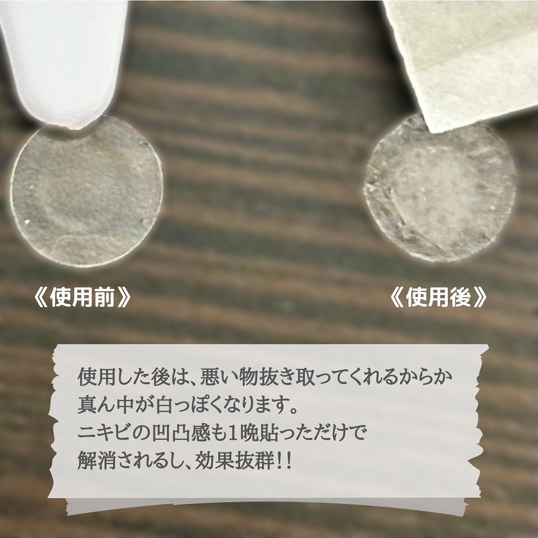 カーミングクリアスポットパッチ/Pyunkang Yul/にきびパッチを使ったクチコミ(7枚目)