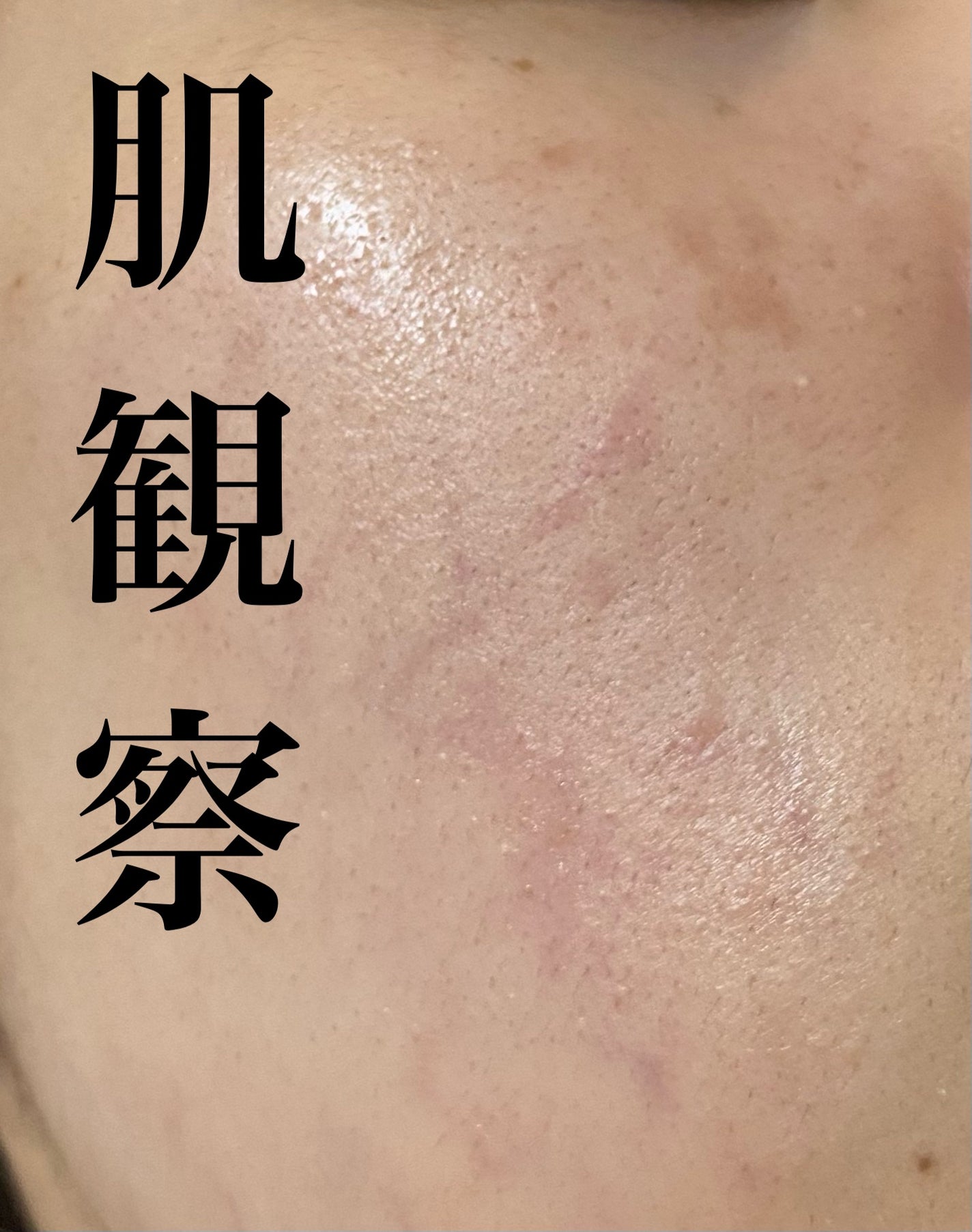 さい on LIPS 「美容医療に手を出し始めて1ヶ月が経ちました🗓️はじめはケミカル..」(1枚目)