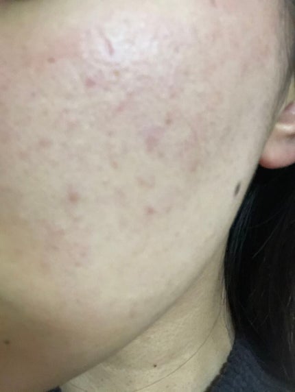 orange_beauty_3vmw on LIPS 「毛穴なくなる!と記載されていたものを沢山使用しましたが、一向に..」(2枚目)
