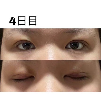 七瀬 on LIPS 「初投稿失礼します!この度ついに念願の二重埋没をしてきました〜!..」(6枚目)