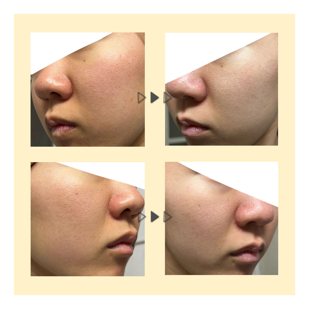 ハトムギ化粧水(ナチュリエ スキンコンディショナー R )/ナチュリエ/化粧水を使ったクチコミ（3枚目）