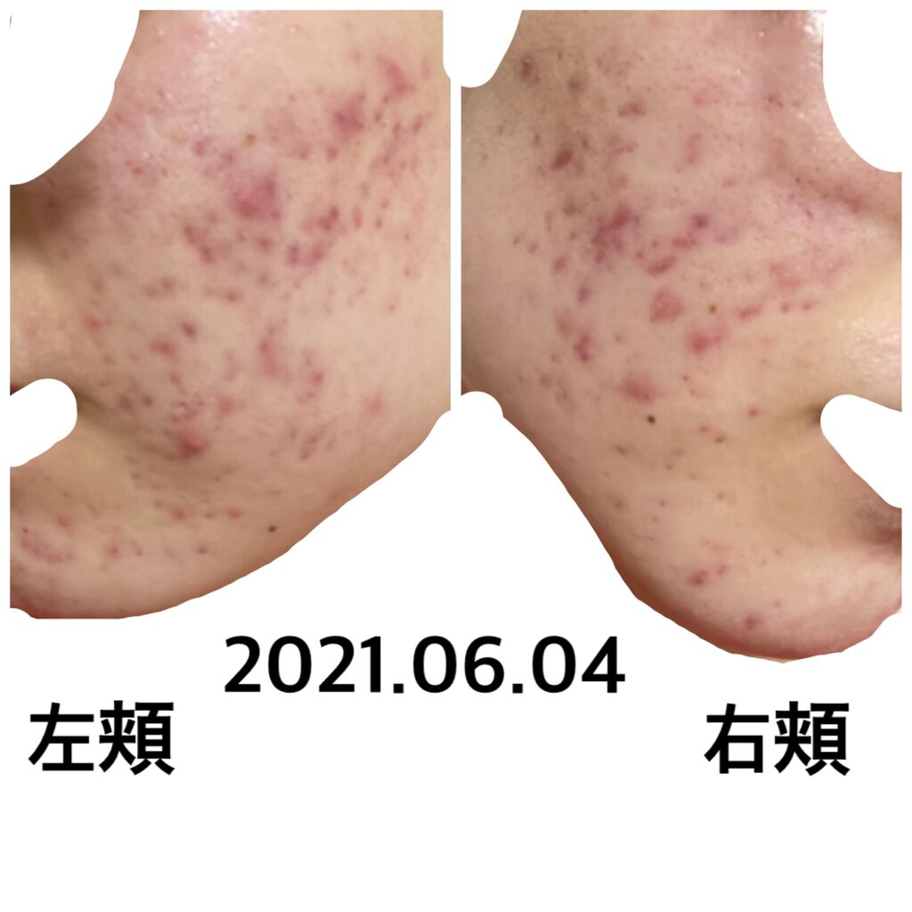 ぺここ on LIPS 「ニキビ跡記録実家で撮影ひどくなってる気がする😭..」(1枚目)