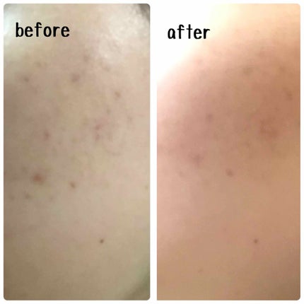 皮脂トラブルケア ミニセット 化粧水/キュレル/スキンケアキットの画像