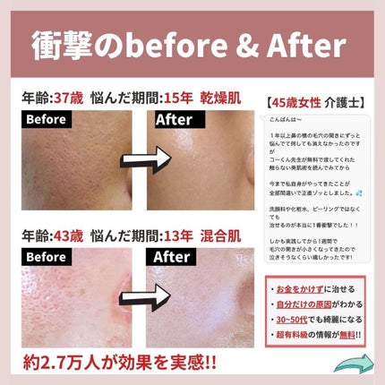 あなたの肌に合ったスキンケア💐コーくん先生 on LIPS 「【毛穴消したい人だけ見てください。】10年悩んだ毛穴の開き3日..」(6枚目)