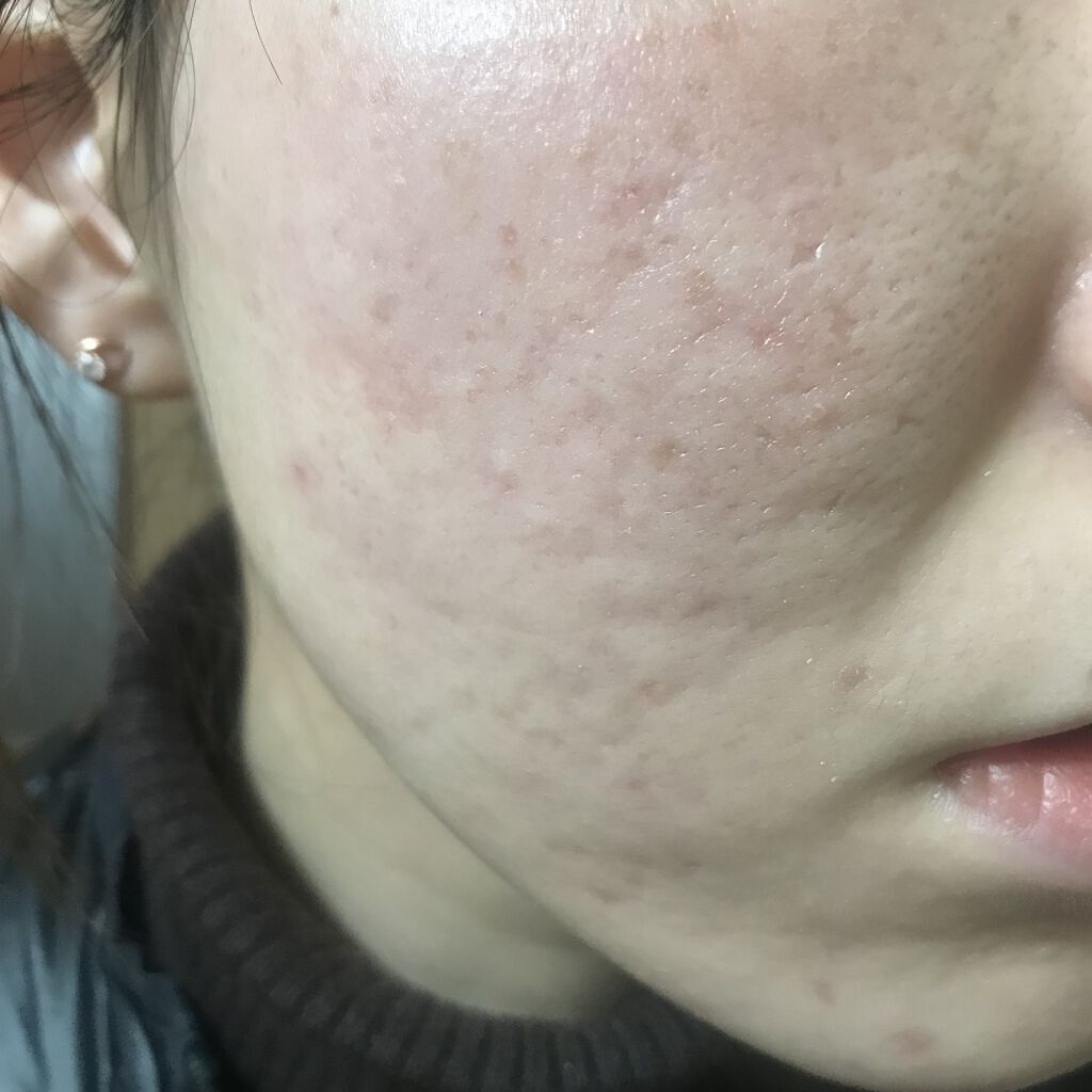 ラディアントクリーミーコンシーラー/NARS/リキッドコンシーラーを使ったクチコミ（2枚目）