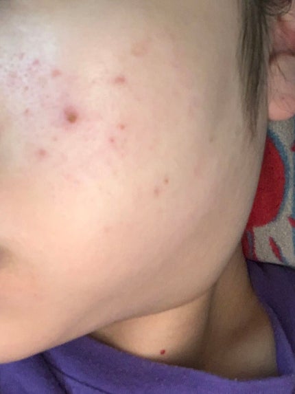 シーバム クリーン ウォーター ACモイスト/ACSEINE/化粧水を使ったクチコミ(2枚目)