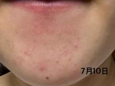 ささ on LIPS 「【ニキビが一個でも病院に行きましょう！】ニキビは尋常性ざ瘡とい..」（2枚目）