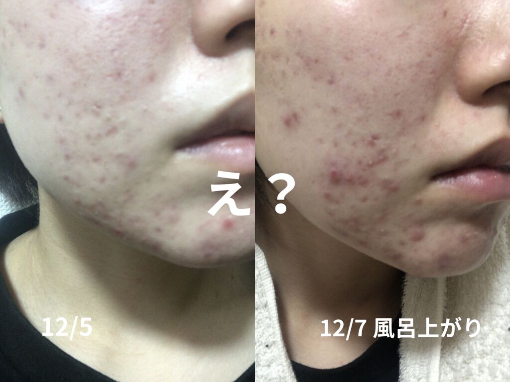 ベリーお元気？/ラッシュ/洗い流すパック・マスクを使ったクチコミ（2枚目）