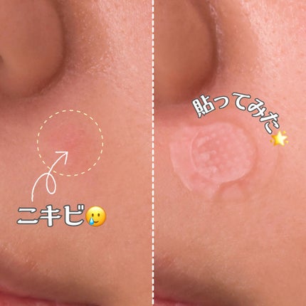 トゥルーダイブマイクロニードルパッチ/大熊製薬/にきびパッチを使ったクチコミ(5枚目)