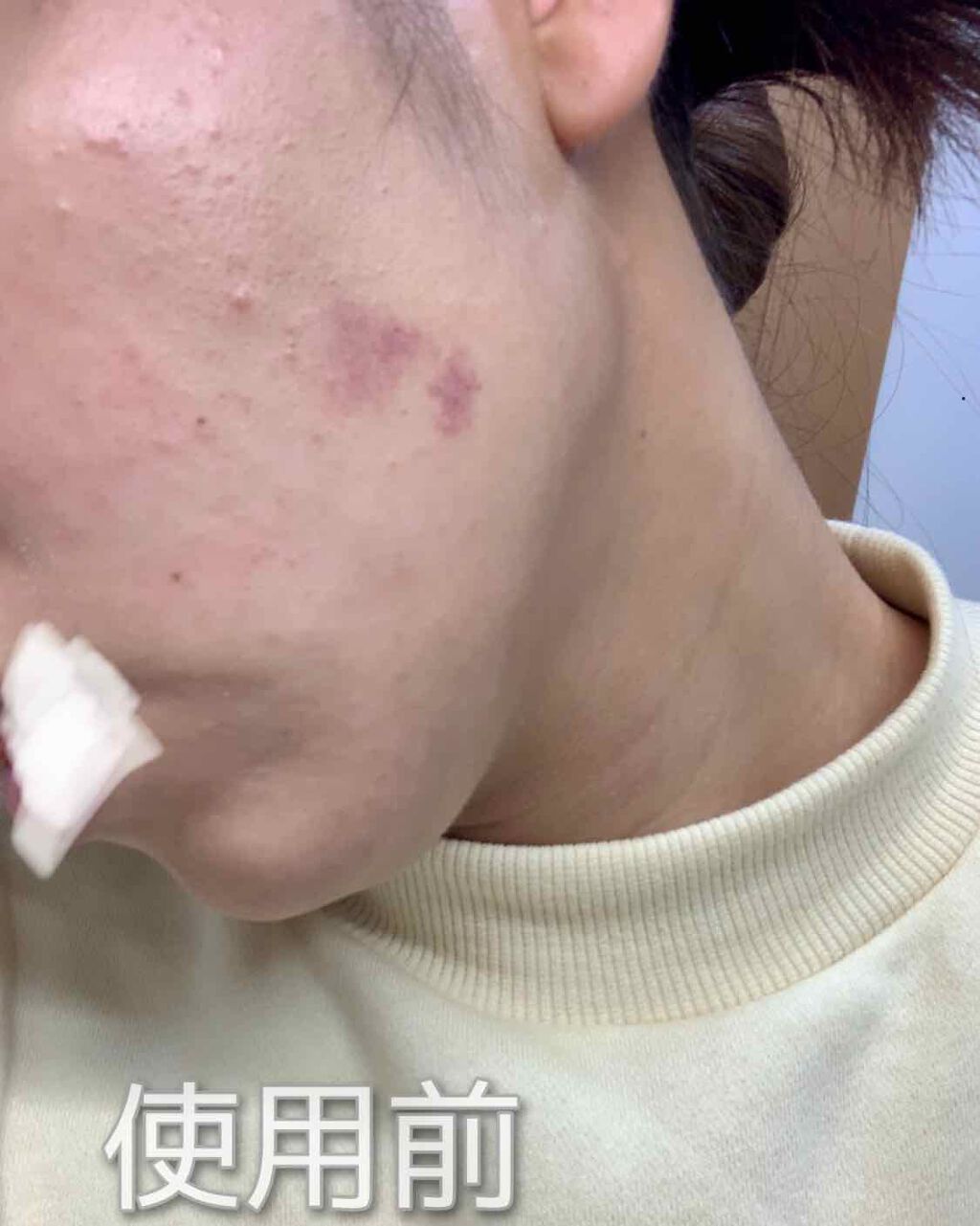 ベピオゲル/マルホ株式会社/その他を使ったクチコミ（2枚目）