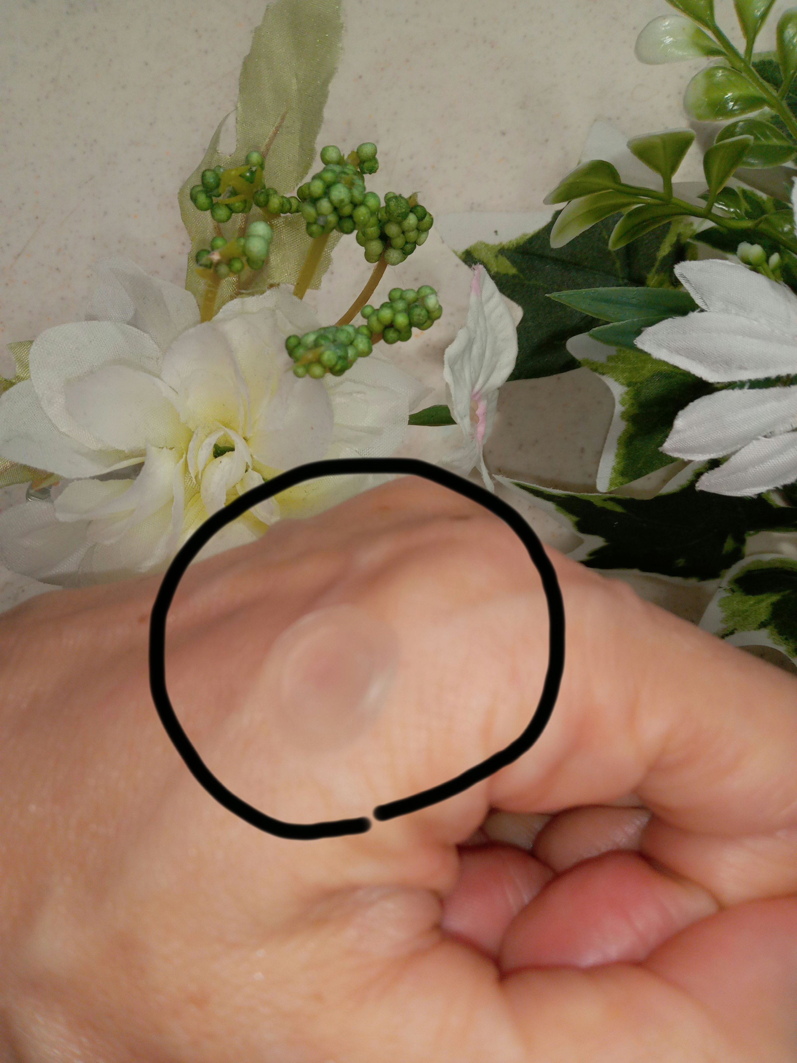 エーキュアショットスポットパッチ/obsero/にきびパッチを使ったクチコミ（2枚目）