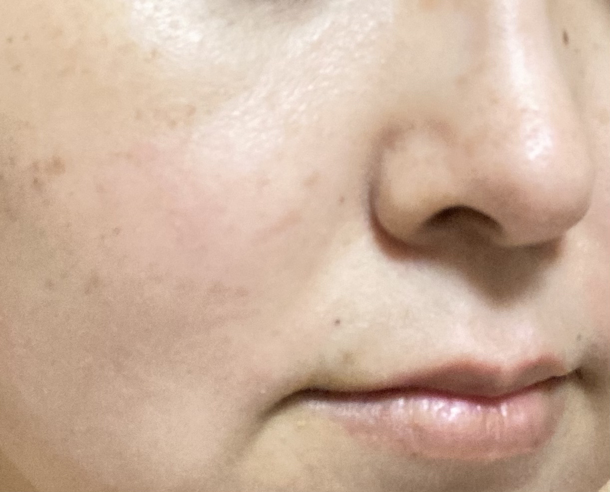 薬用プロテクトスポッツ 薬用プロテクトスポッツ/アクネバリア/美容液を使ったクチコミ（1枚目）