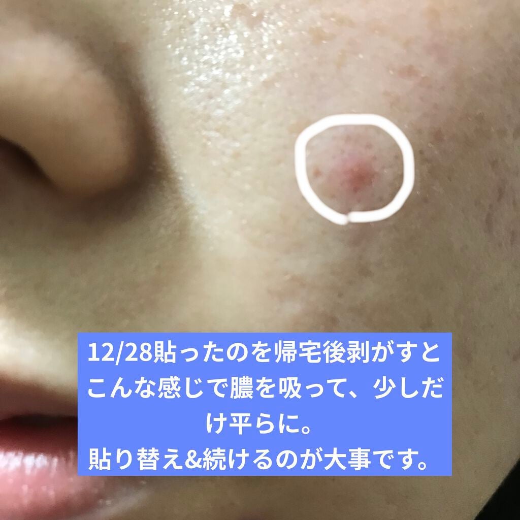 プロCICA クリアスポットパッチ/VT/その他スキンケアを使ったクチコミ(10枚目)