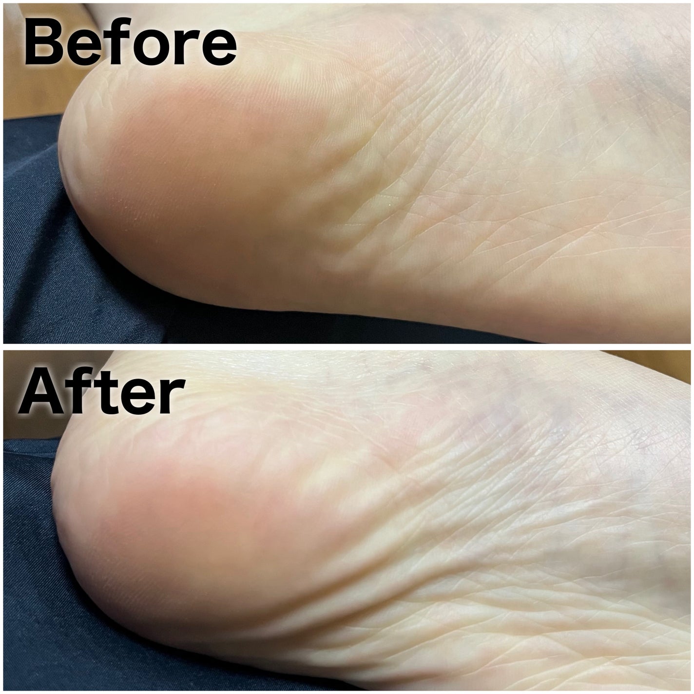 イージーパックDP60分タイプ/ベビーフット/レッグ・フットケアを使ったクチコミ(5枚目)