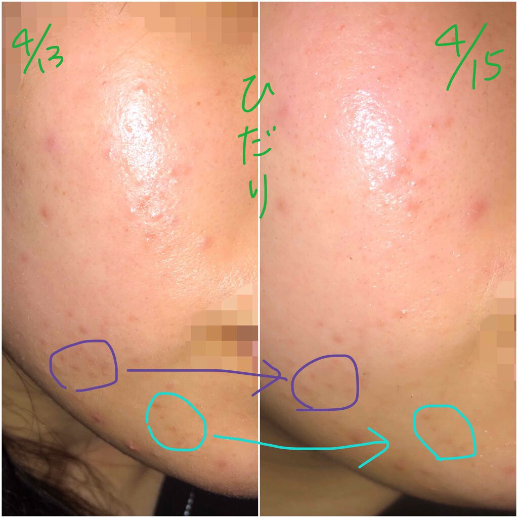 薬用 しみ 集中対策 美容液/メラノCC/美容液を使ったクチコミ(2枚目)