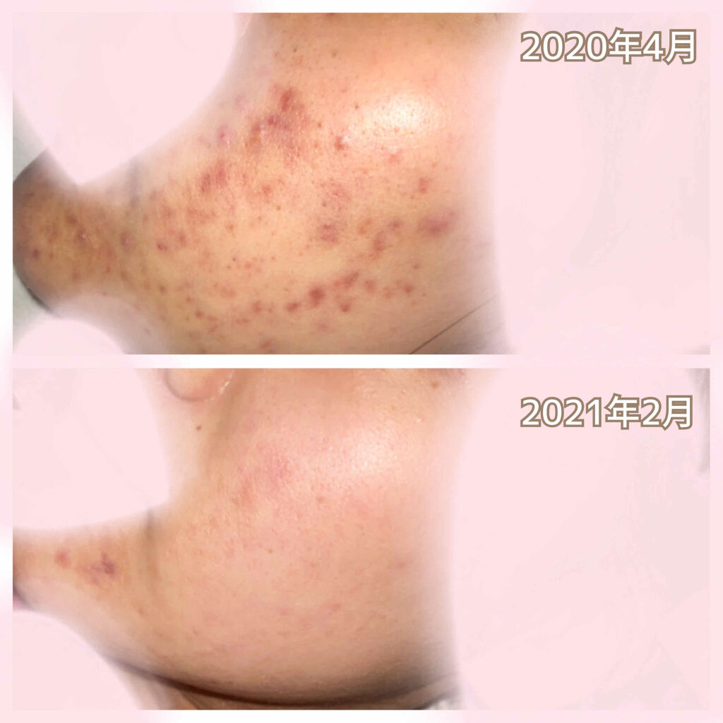 ノブ Ａ アクネソープ/NOV/洗顔石鹸を使ったクチコミ（2枚目）