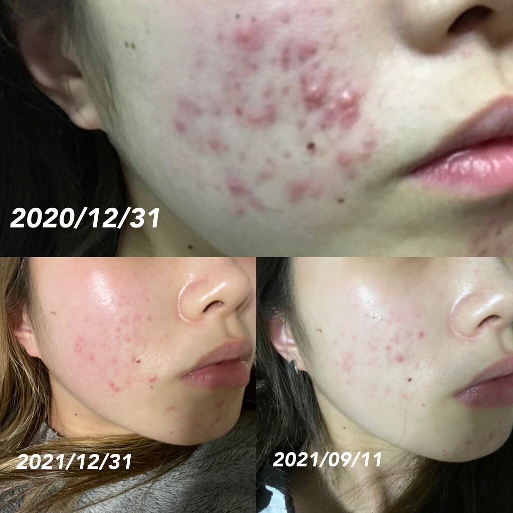 イハダ 薬用バーム【医薬部外品】/IHADA/フェイスバームを使ったクチコミ(4枚目)