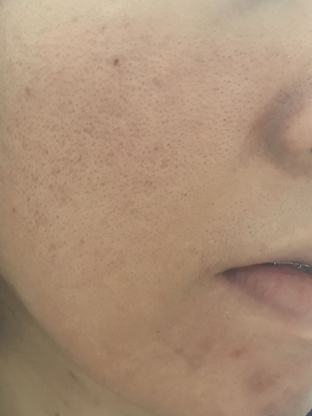 メディカルクリームc(医薬品)/メンソレータム アクネス25/その他を使ったクチコミ（2枚目）