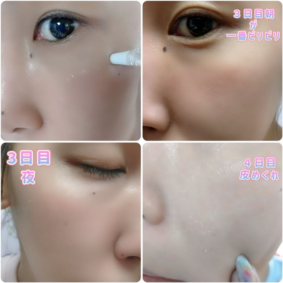 ダーマスキンピーリング/BQCELL/その他キットセットを使ったクチコミ(6枚目)