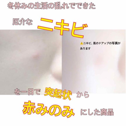 ACC パッチ/ETUDE/シートマスク・パックを使ったクチコミ(1枚目)