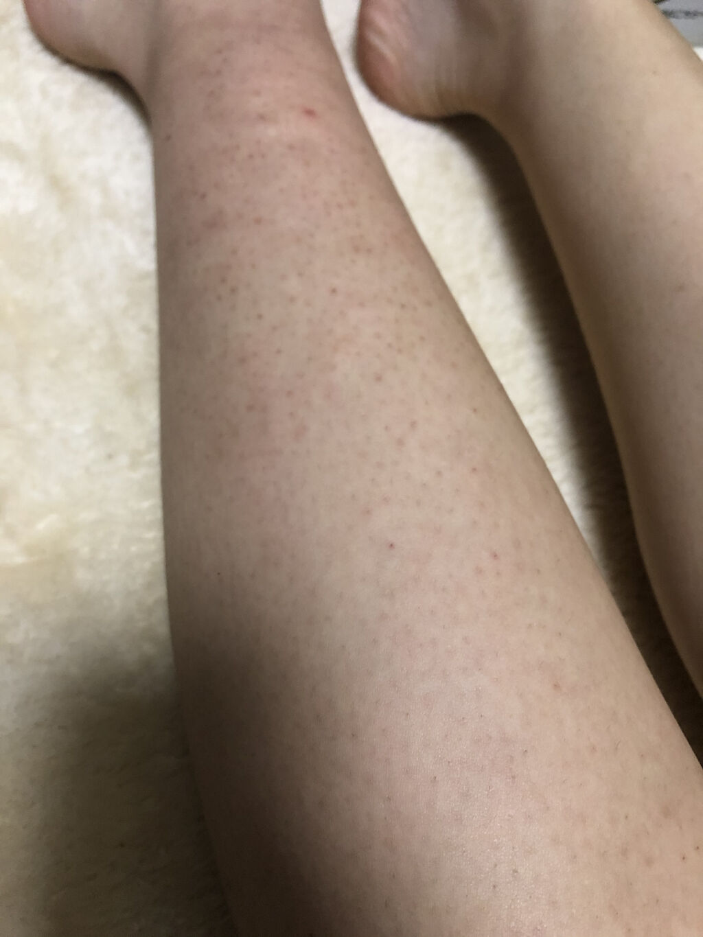 ケアノキュア（医薬品）/小林製薬/その他を使ったクチコミ（2枚目）