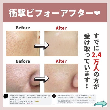 あなたの肌に合ったスキンケア💐コーくん先生 on LIPS 「【本当は教えたくない】毛穴の開きコレで消えます🔥.
.
あなた..」(8枚目)