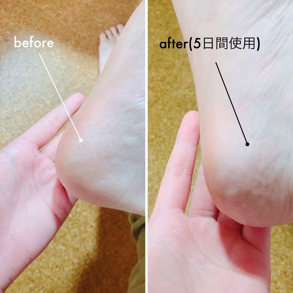 ツルリ集中ボディケアセット/ツルリ/スキンケアキットを使ったクチコミ(4枚目)