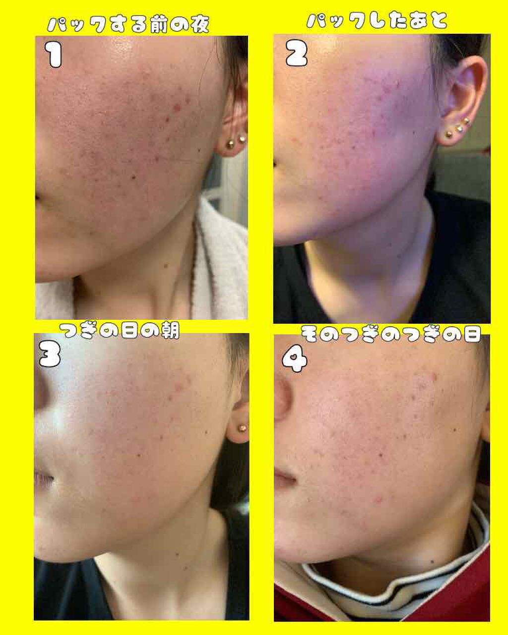 ティーツリーケア ソリューション エッセンシャルマスクEX/MEDIHEAL/シートマスク・パックを使ったクチコミ(2枚目)