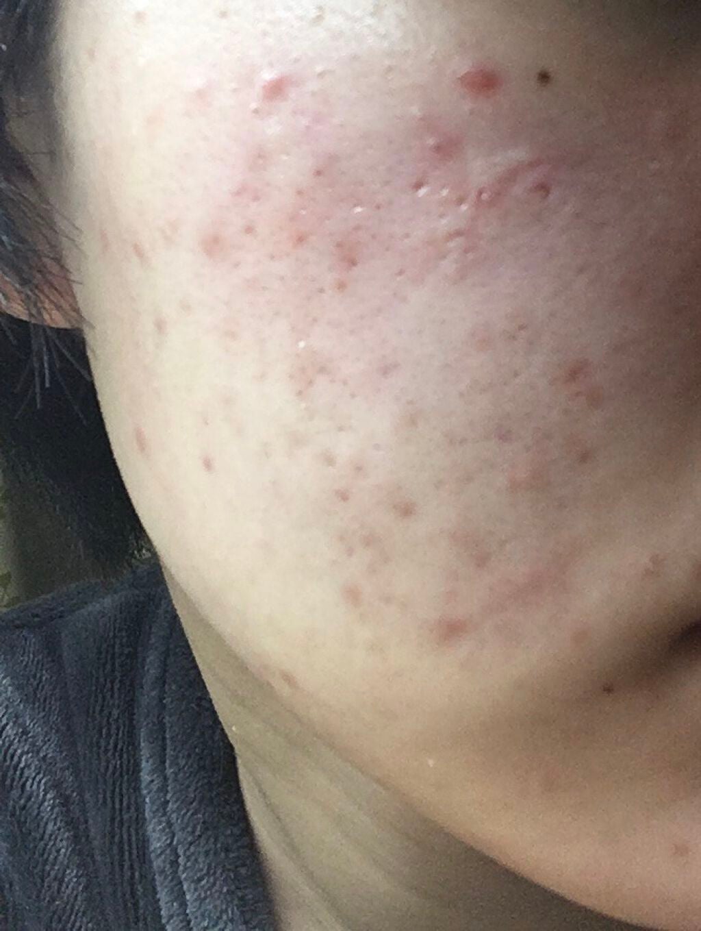 coral_glow_1f1z on LIPS 「コメントくださいこの様な毛穴や、ニキビ跡はどーすれば良いのでし..」(1枚目)