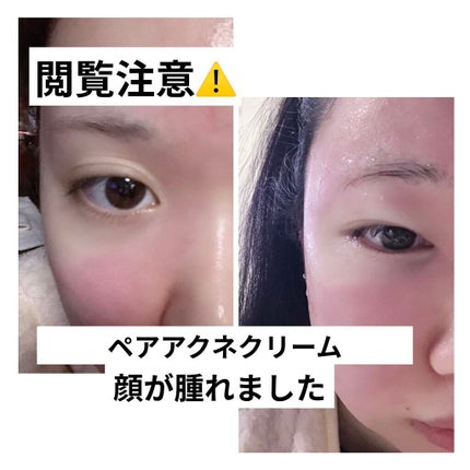 ペアアクネクリームW(医薬品)/ペア/その他を使ったクチコミ(1枚目)