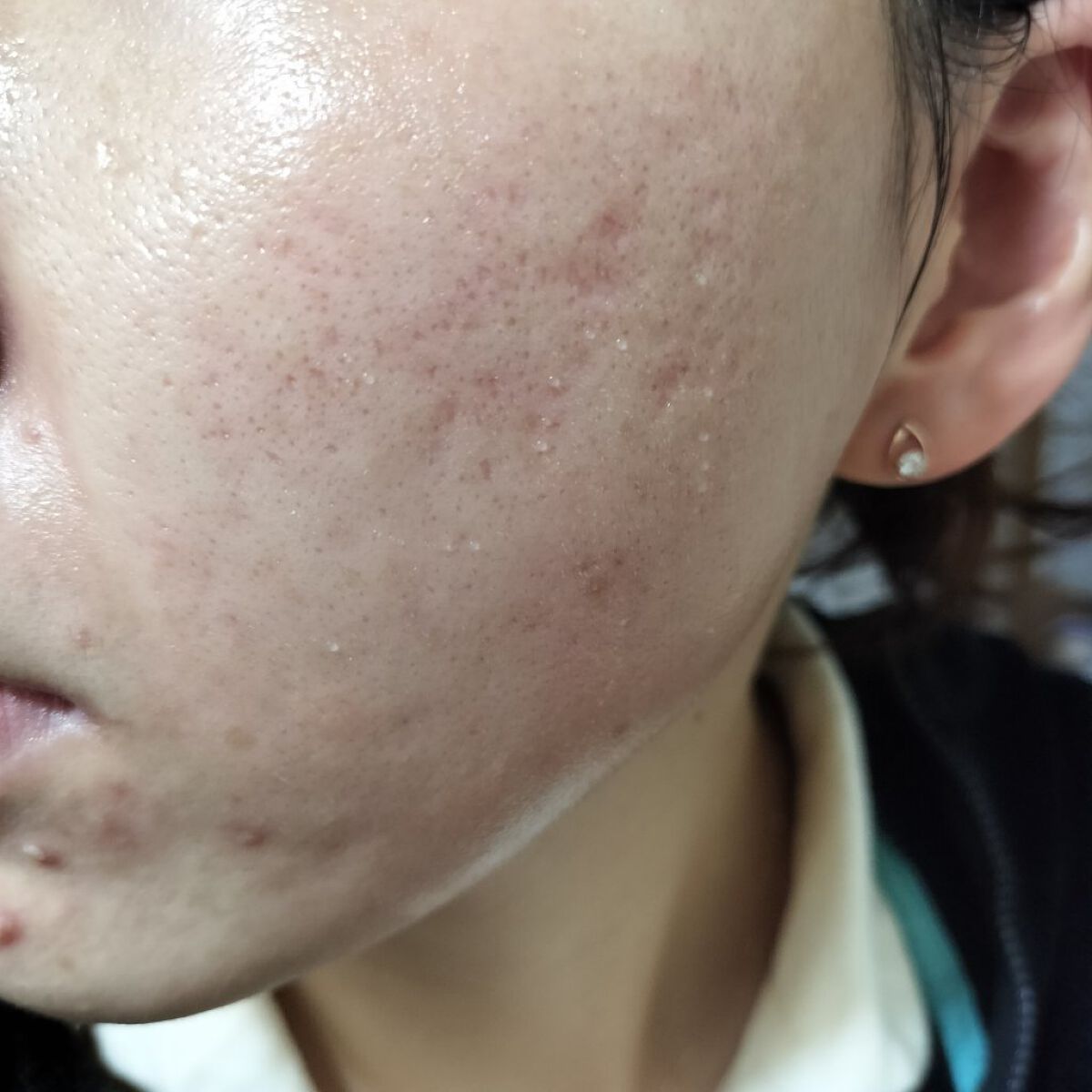 Azelaic Acid Suspension 10%/The Ordinary/美容液を使ったクチコミ（2枚目）