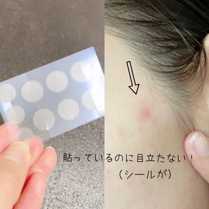 極薄透明パッチ nikipa!/金冠堂/にきびパッチを使ったクチコミ(3枚目)