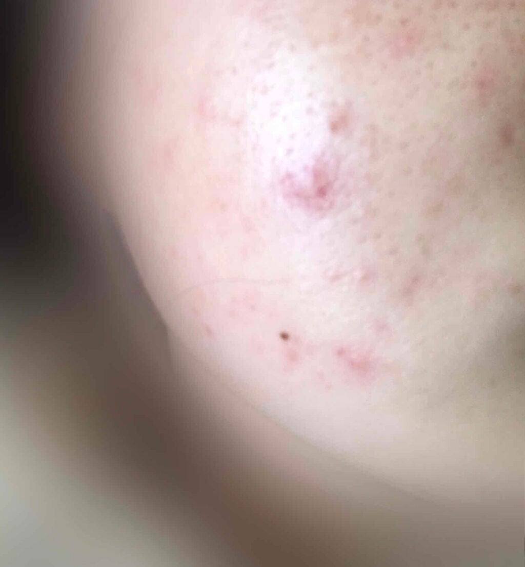 shiny_blush_azhu on LIPS 「⚠️閲覧注意です。病院に何回か行き薬をもらっても効き目が全くな..」(3枚目)