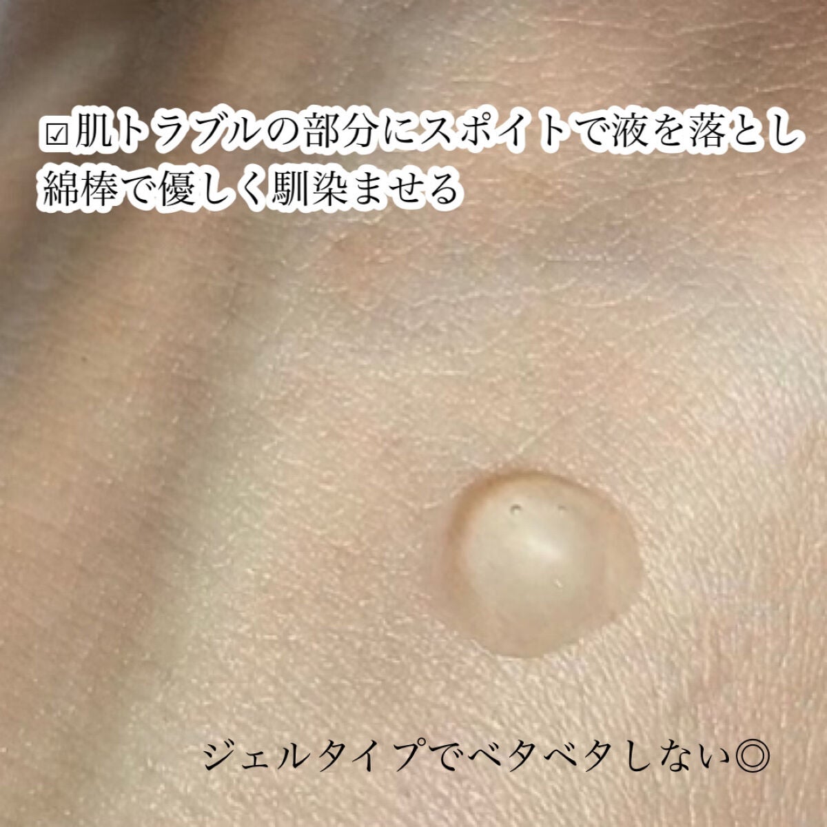 アクニドクターファーストスピーディースポット/ISOI/美容液を使ったクチコミ(5枚目)