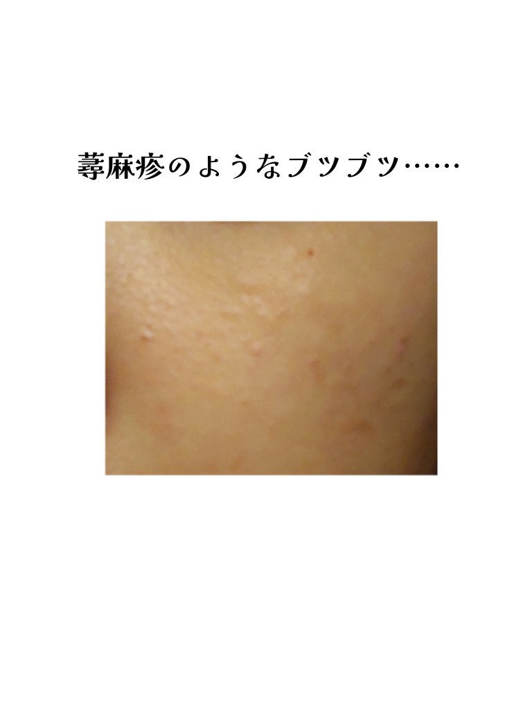 こゆき on LIPS 「❤︎肌断食について❤︎ニキビが気になっていたので、𝙔𝙤𝙪𝙩𝙪𝙗..」(4枚目)