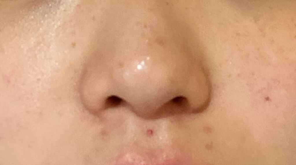 なさ on LIPS 「コメントお願いします🥺肌のことで悩んでいます。ニキビ、ニキビ跡..」(2枚目)