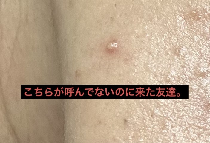 薬用 美白アクネホワイトクリーム 専用パッチ付/アクネスラボ/その他キットセットを使ったクチコミ（3枚目）