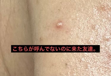 薬用 美白アクネホワイトクリーム 専用パッチ付/アクネスラボ/にきびパッチを使ったクチコミ（3枚目）