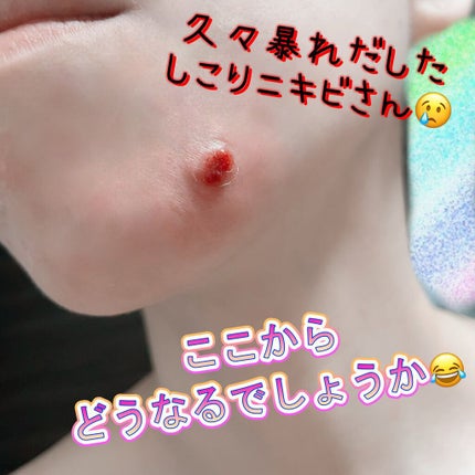 ベトネベートN軟膏AS(医薬品)/第一三共ヘルスケア/その他を使ったクチコミ(2枚目)