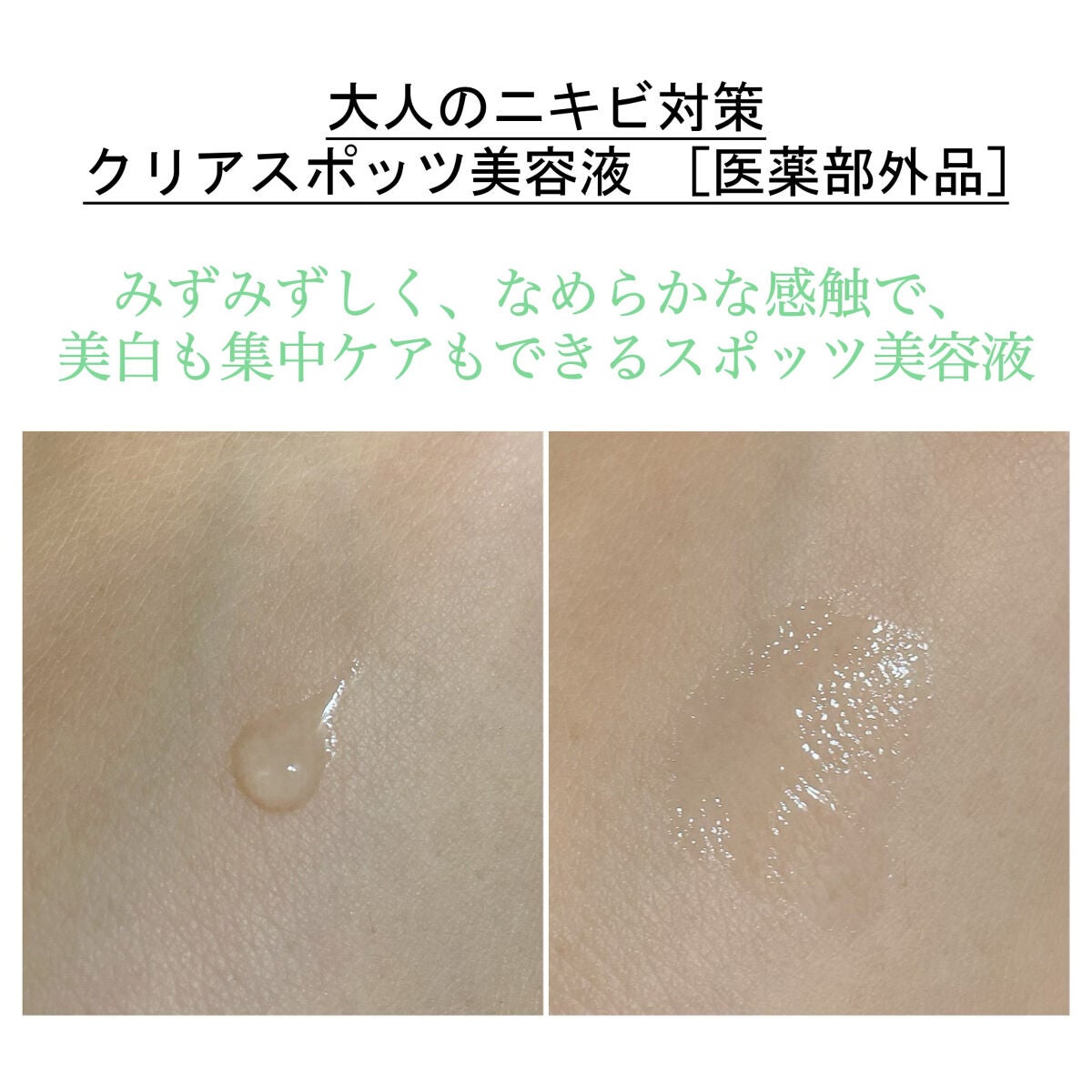 大人のニキビ対策 薬用美白化粧水/肌美精/化粧水を使ったクチコミ(4枚目)