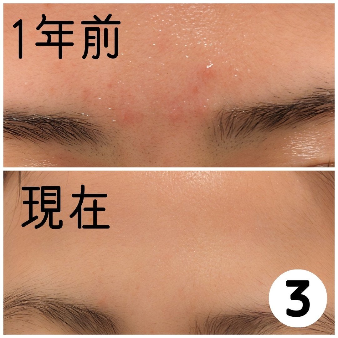 もか【スキンケア】 on LIPS 「【肌荒れが無理すぎて鏡見るのも出かけるのも全瞬間自己嫌悪に陥る..」(5枚目)