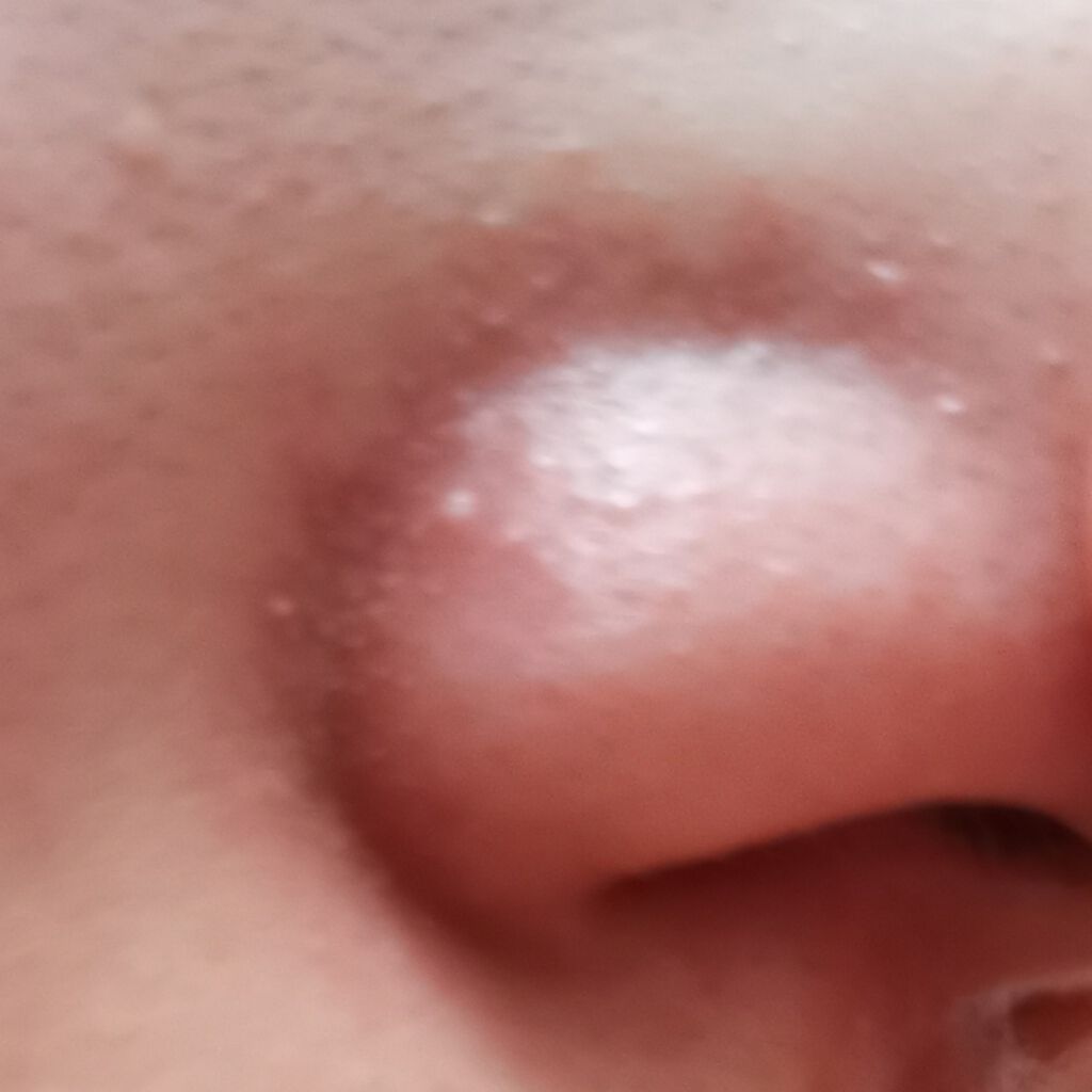 イチゴ鼻薬用はがさないパック【医薬部外品】/フォーミィ/洗い流すパック・マスクを使ったクチコミ（2枚目）