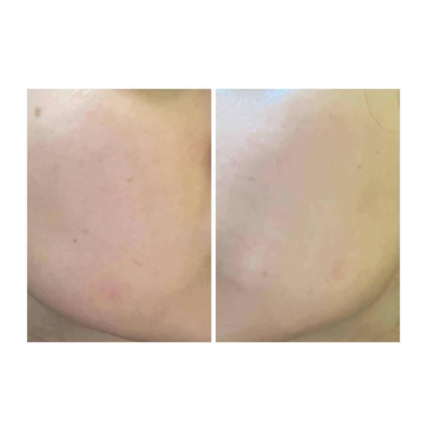 ぽむ on LIPS 「2023.9.13皮膚科に受診 エピデュオとヘパリン処方1枚目..」(4枚目)