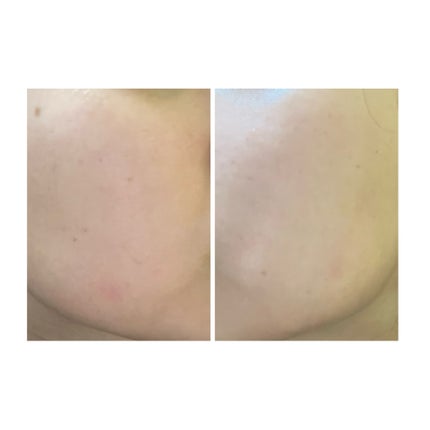 ぽむ on LIPS 「2023.9.13皮膚科に受診 エピデュオとヘパリン処方1枚目..」(4枚目)