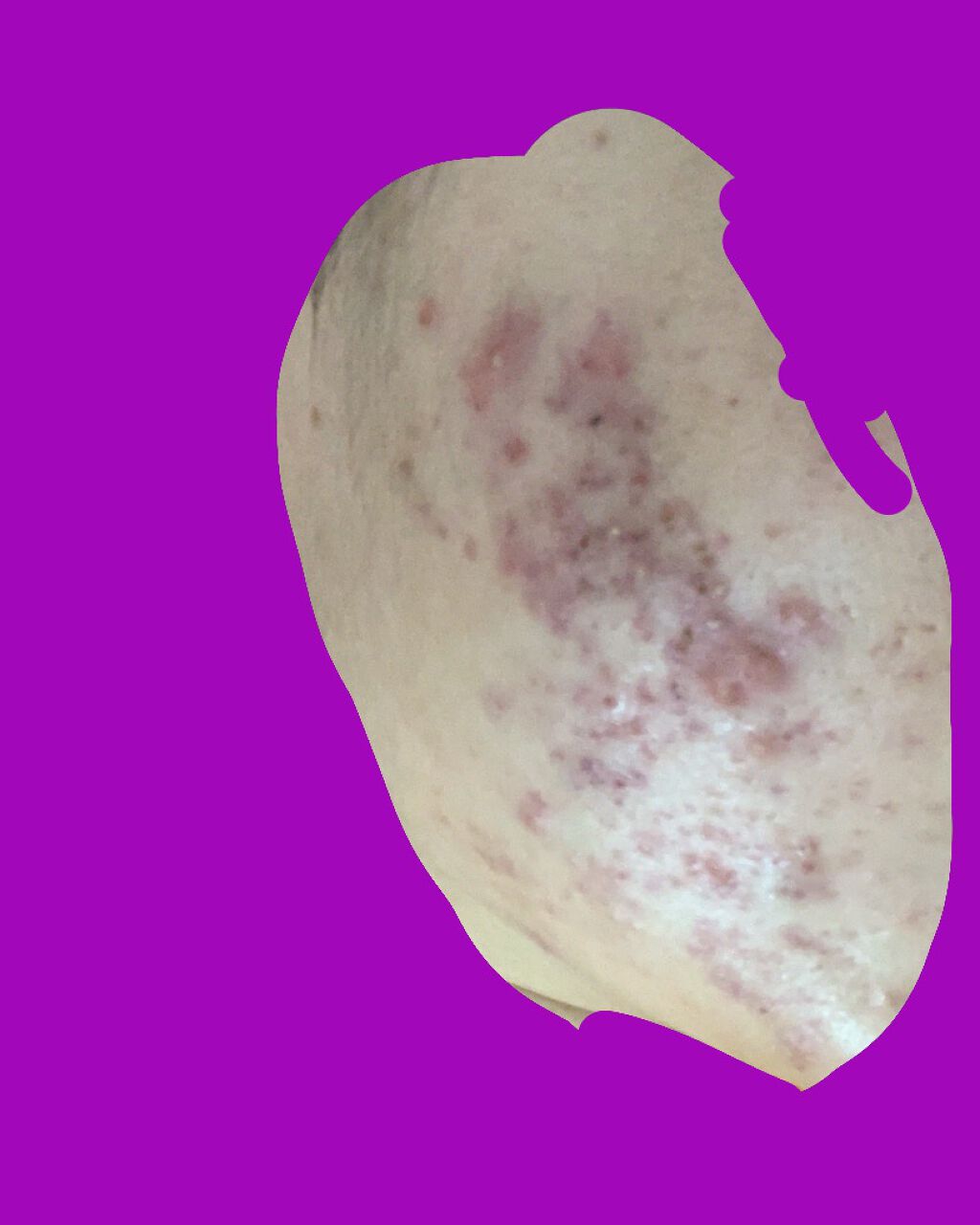 fantastic_lips_wb15 on LIPS 「ニキビ2ヶ月、皮膚科通ってて、しっかり薬塗ってても全然治りませ..」(1枚目)