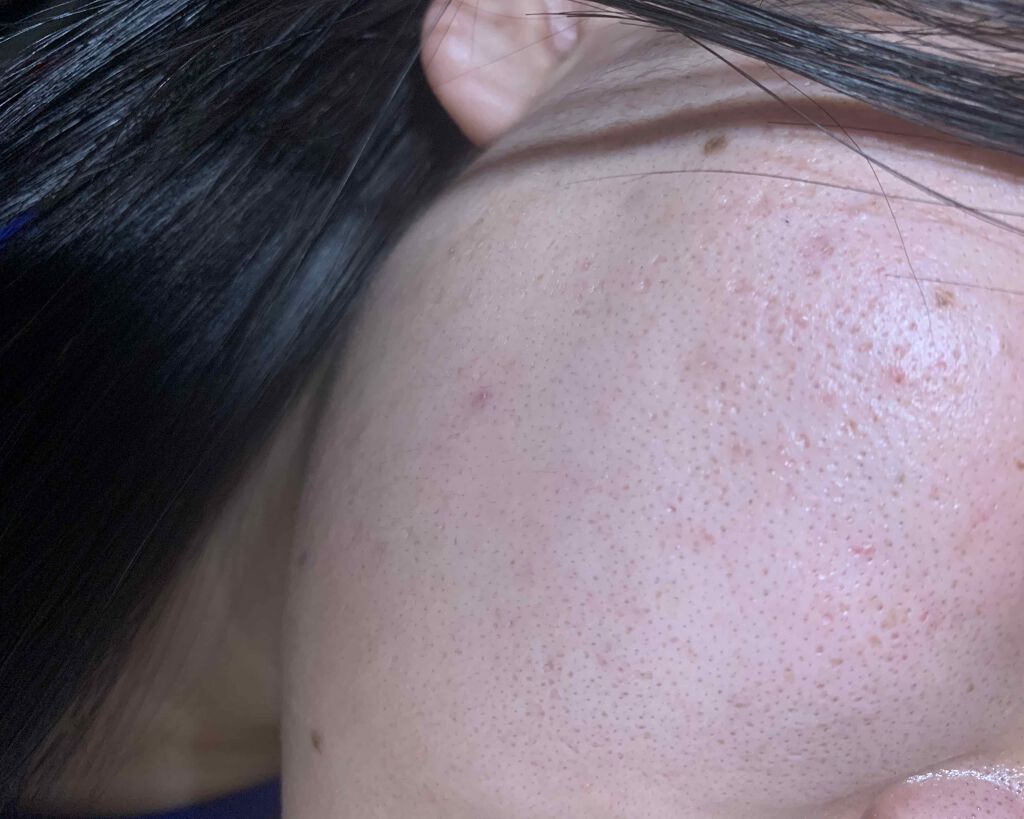 きつね on LIPS 「肌が小学生から汚いです。高校生になりましたが、中々綺麗になりま..」(2枚目)